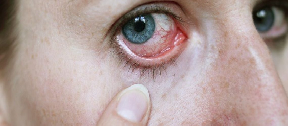 دکتر آلرژی چشم