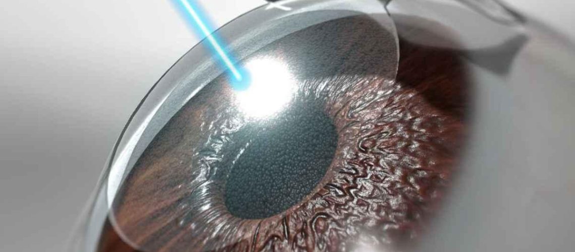 دکتر عمل لیزیک و لازک