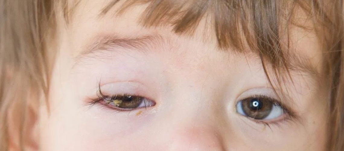 دکتر میکروفتالموس